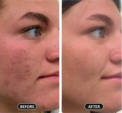 Bye Bye Acne Protocol